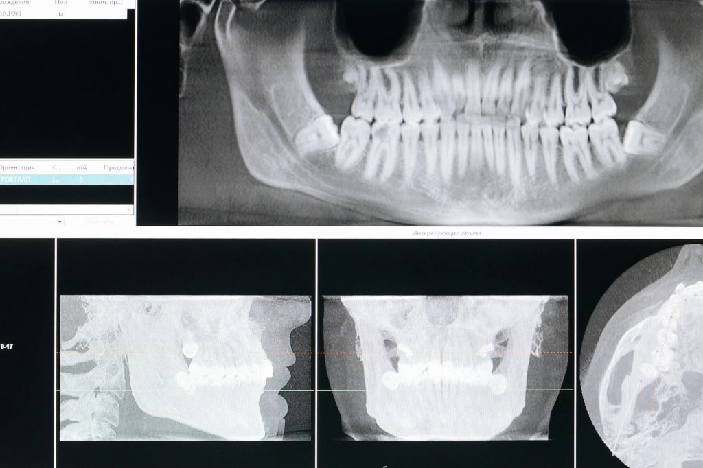 full mouth reconstruction by San Antonio Oral & Maxillofacial Surgery