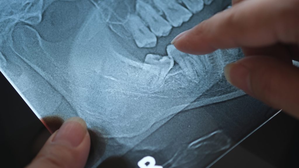 iStock 2164978517 scaled 1 by San Antonio Oral & Maxillofacial Surgery